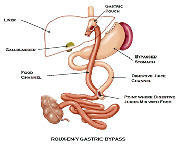 roux en y gastric bypass anatomy